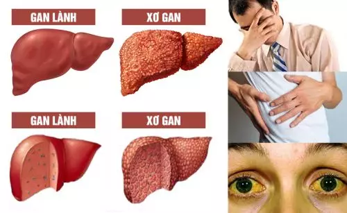 Người bị xơ gan cổ trướng thường gầy yếu, đau hạ sườn phải, vàng da